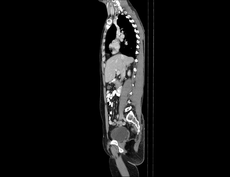File:Addison disease (Radiopaedia 49318-54412 Sagittal C+ portal venous phase 42).jpg