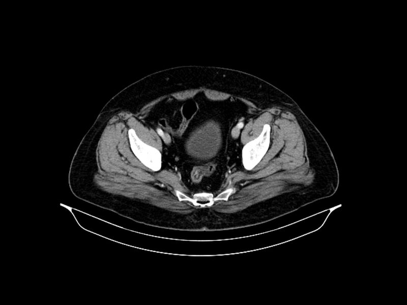 File:Adenocarcinoma of pancreas with hepatic metastasis (Radiopaedia 64332-73122 Axial C+ portal venous phase 88).jpg
