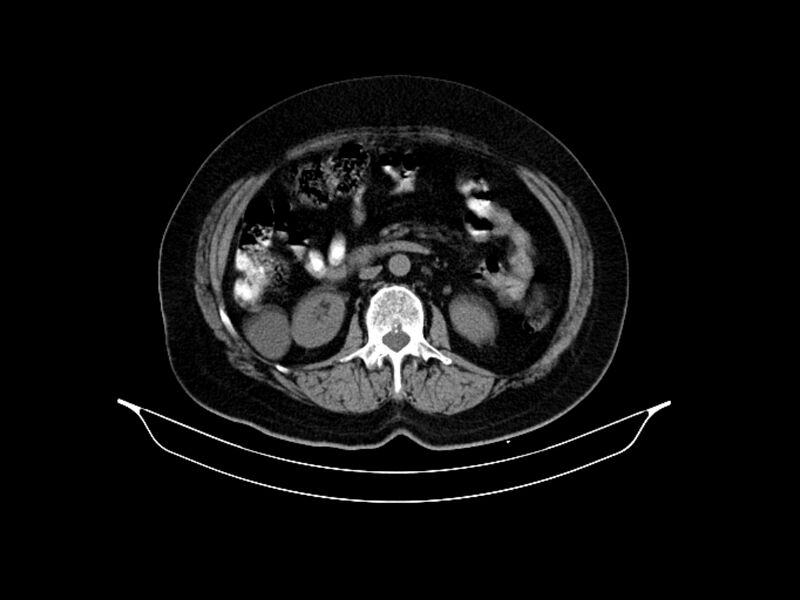 File:Adenocarcinoma of pancreas with hepatic metastasis (Radiopaedia 64332-73122 Axial non-contrast 49).jpg