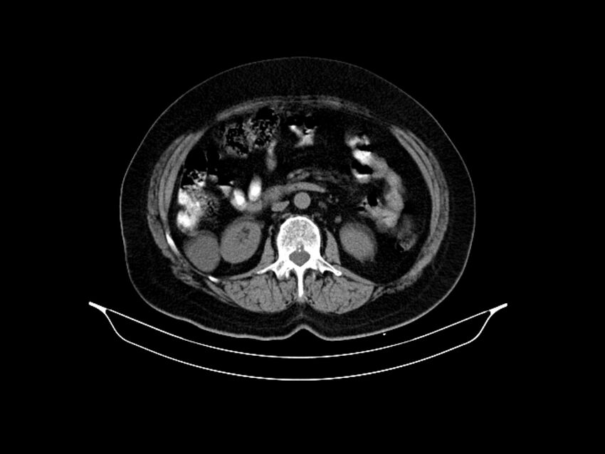 Adenocarcinoma of pancreas with hepatic metastasis (Radiopaedia 64332-73122 Axial non-contrast 49).jpg