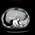 Adenocarcinoma of the colon (Radiopaedia 8191-9039 Axial liver window 13).jpg