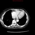 Adenocarcinoma of the colon (Radiopaedia 8191-9039 Axial liver window 5).jpg