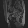 Adenoma malignum of the cervix (Radiopaedia 24460-24765 T2 93).jpg