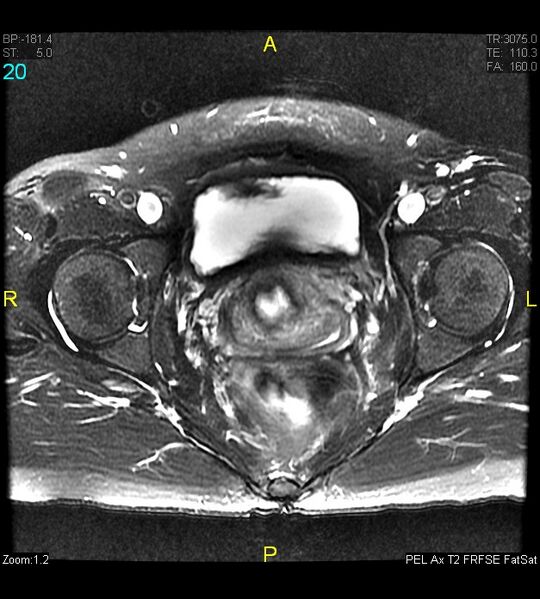 File:Adenomyosis (Radiopaedia 43504-46889 Axial T2 fat sat 20).jpg