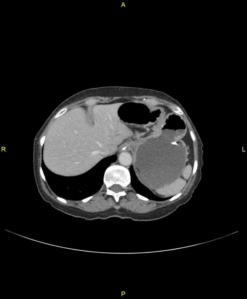 Adhesional small bowel obstruction (Radiopaedia 85402-101024 Axial C+ portal venous phase 48).jpg