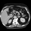 Adrenal hemangioma (Radiopaedia 11039-11445 Axial C+ portal venous phase 6).jpg