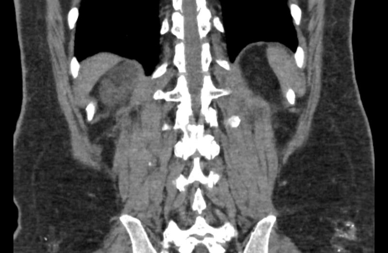 File:Adrenal myelolipoma (Radiopaedia 65240-74253 Coronal non-contrast 61).jpg
