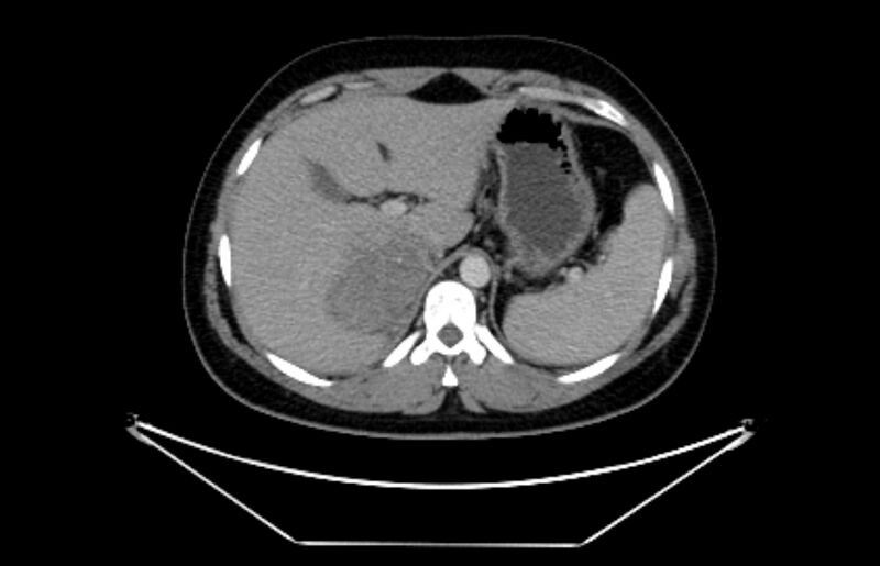 File:Adrenocortical carcinoma (Radiopaedia 80134-93438 Axial C+ portal venous phase 31).jpg