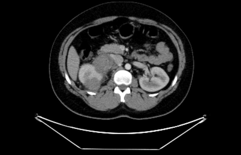 File:Adrenocortical carcinoma (Radiopaedia 80134-93438 Axial C+ portal venous phase 54).jpg