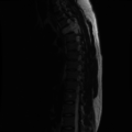 Aggressive vertebral hemangioma (Radiopaedia 39937-42404 Sagittal T2 6).png