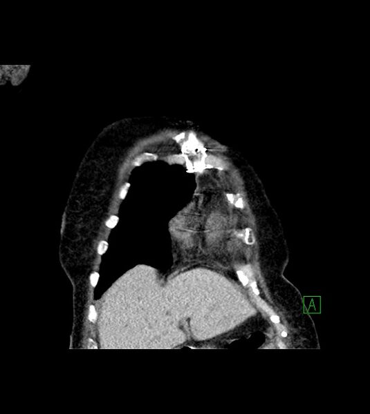 File:Amiodarone deposition in the liver (Radiopaedia 77587-89780 Coronal non-contrast 17).jpg