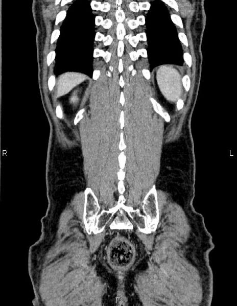 File:Ampullary adenocarcinoma (Radiopaedia 86093-102032 C 60).jpg