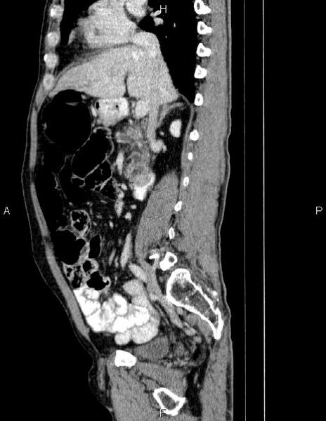 File:Ampullary adenocarcinoma (Radiopaedia 86093-102032 D 38).jpg