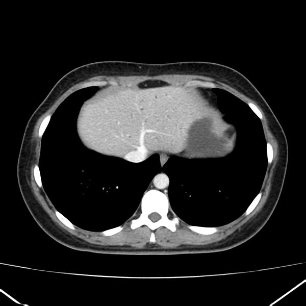 File:Ampullary tumor (Radiopaedia 22787-22816 C 7).jpg