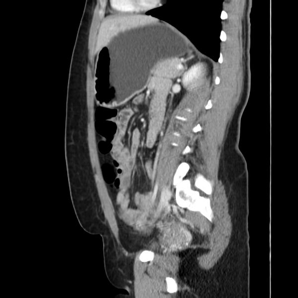File:Ampullary tumor (Radiopaedia 22787-22816 D 35).jpg