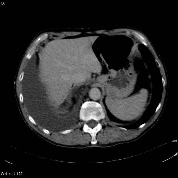 File:Amyloidoma - mediastinal (Radiopaedia 6711-7925 B 35).jpg