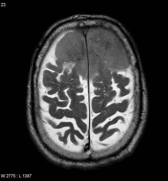 File:Anaplastic meningioma (Radiopaedia 5553-7290 Axial T2 1).jpg