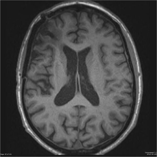 File:Anaplastic meningioma with recurrence (Radiopaedia 34452-35788 Axial T1 81).jpg