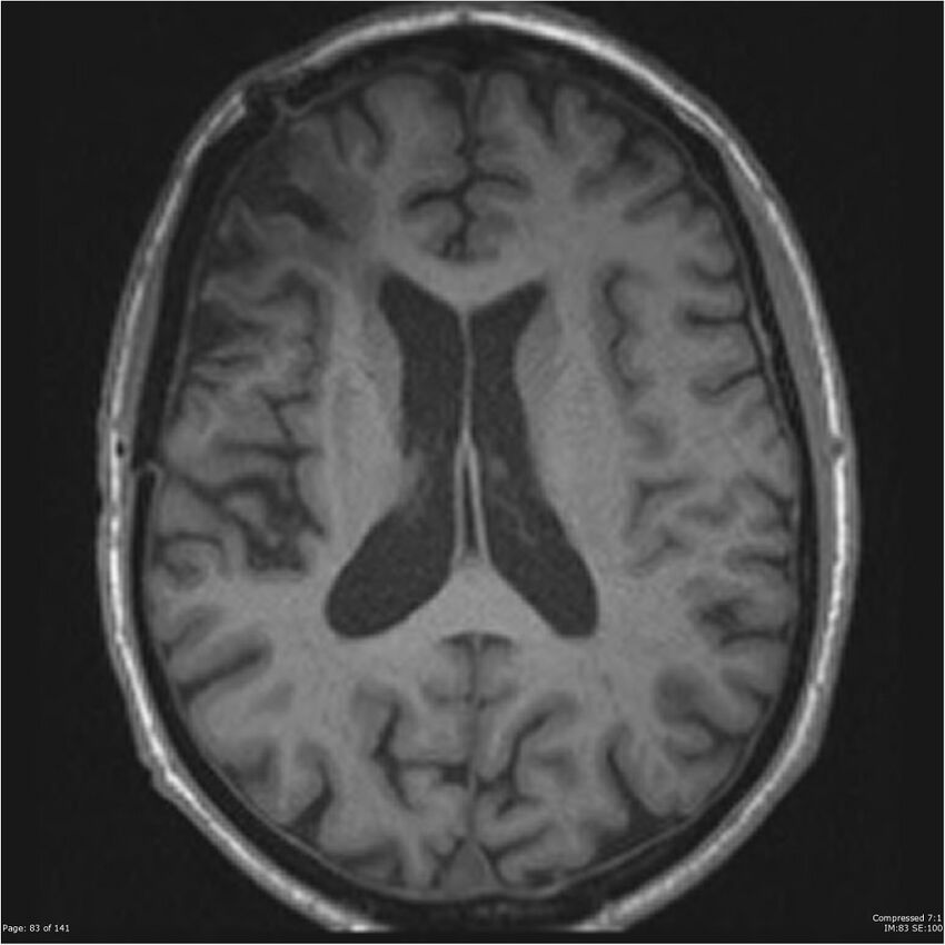 Anaplastic meningioma with recurrence (Radiopaedia 34452-35788 Axial T1 81).jpg