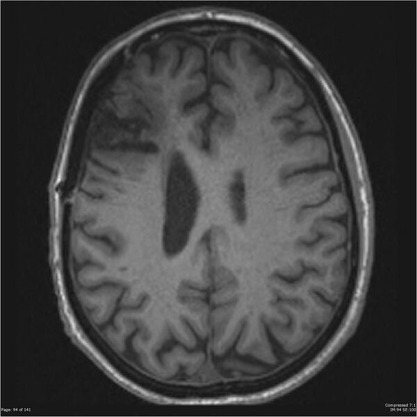 File:Anaplastic meningioma with recurrence (Radiopaedia 34452-35788 Axial T1 92).jpg