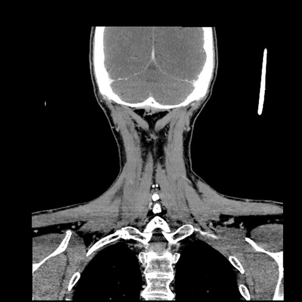 File:Anaplastic thyroid carcinoma (Radiopaedia 79087-92034 A 96).jpg