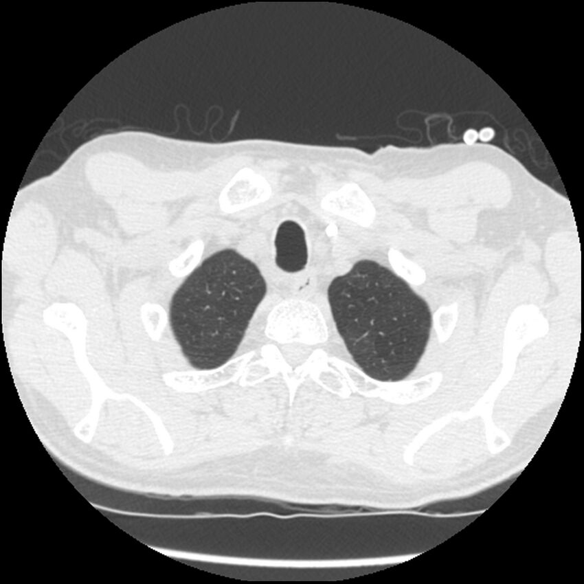 Angioinvasive aspergillosis (Radiopaedia 43957-47466 Axial lung window 9).jpg
