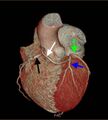 Anomalous left coronary artery- prepulmonic course (Radiopaedia 29253-29667 3D VRT 2).jpg