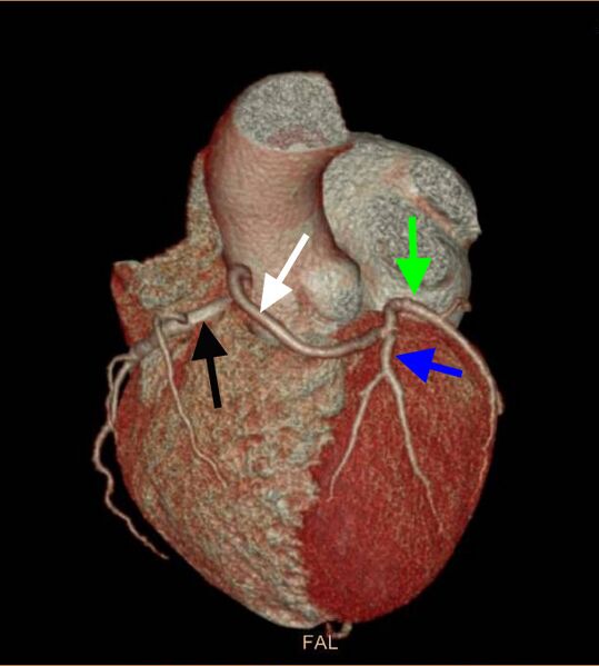 File:Anomalous left coronary artery- prepulmonic course (Radiopaedia 29253-29667 3D VRT 2).jpg