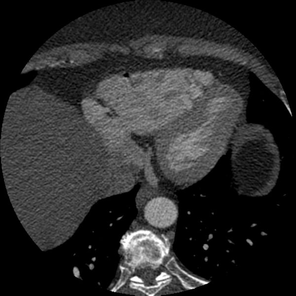 File:Anomalous origin of left circumflex artery from right coronary sinus (Radiopaedia 72563-83117 B 142).jpg