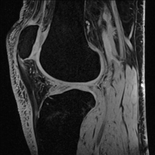 File:Anterior cruciate ligament tear - ramp lesion (Radiopaedia 71883-82322 Sagittal T1 vibe 57).jpg