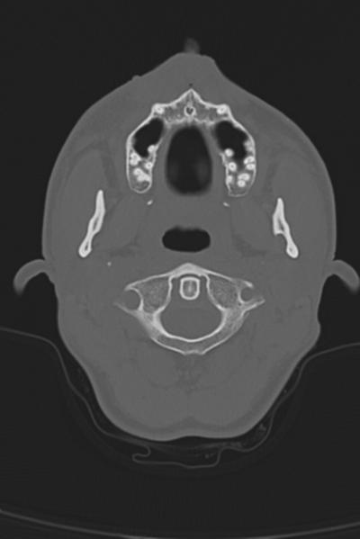 File:Anterior nasal spine fracture (Radiopaedia 46138-50494 Axial bone window 57).png