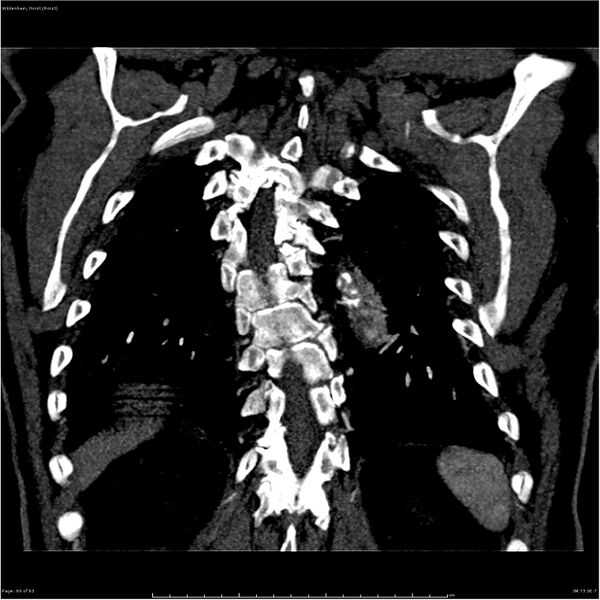 File:Aortic dissection - Stanford type A (Radiopaedia 26183-26315 A 60).jpg