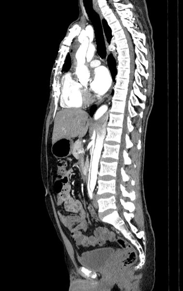 File:Aortic dissection - Stanford type A (Radiopaedia 83418-98500 B 34).jpg