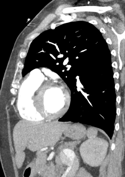 File:Aortic dissection - Stanford type B (Radiopaedia 50171-55512 C 15).png