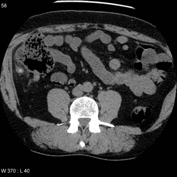 File:Appendicitis (Radiopaedia 12510-12733 Axial non-contrast 25).jpg