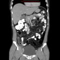 Appendicitis and renal cell carcinoma (Radiopaedia 17063-16760 B 12).jpg
