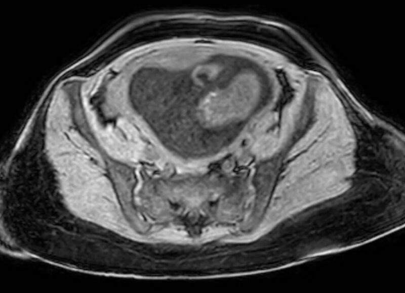 File:Appendicitis in gravida (MRI) (Radiopaedia 89433-106395 Axial DIXON 113).jpg