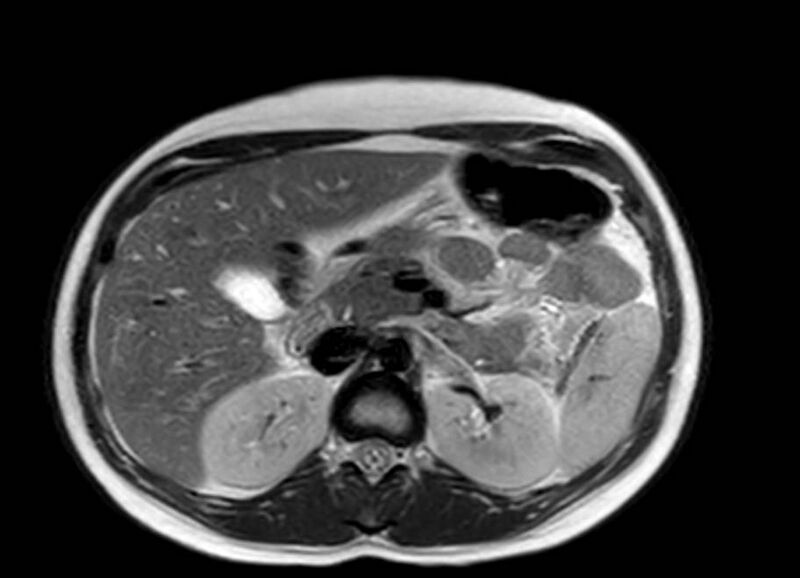 File:Appendicitis in gravida (MRI) (Radiopaedia 89433-106395 Axial T2 19).jpg