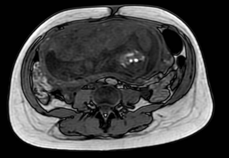 File:Appendicitis in gravida (MRI) (Radiopaedia 89433-106395 D 38).jpg