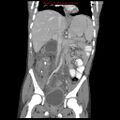 Appendicitis with phlegmon (Radiopaedia 9358-10046 B 36).jpg