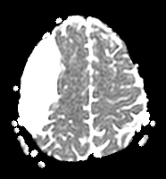 File:Arachnoid cyst- extremely large (Radiopaedia 68741-78451 Axial ADC 20).jpg