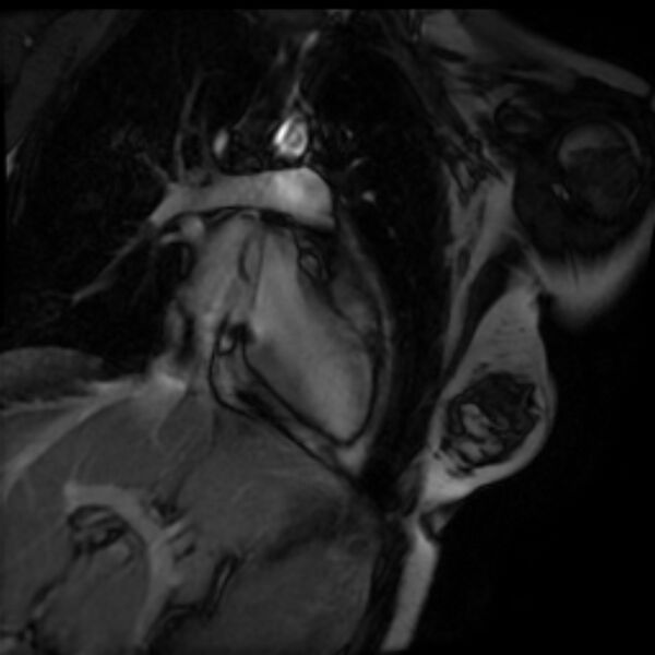File:Arrhythmogenic right ventricular cardiomyopathy (Radiopaedia 87505-103850 2ch (LV) Cine SSFP 5).jpg