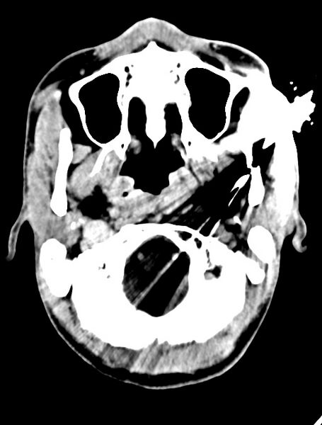 File:Arrow injury to the face (Radiopaedia 73267-84011 Axial C+ delayed 32).jpg