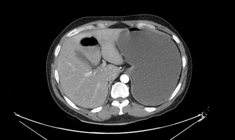File:Arterial occlusive mesenteric ischemia (Radiopaedia 84641-100060 A 31).jpg