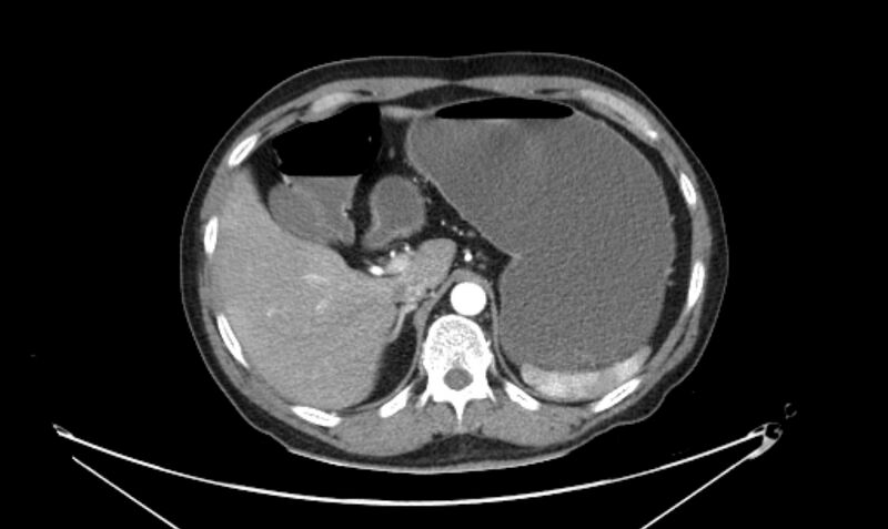 File:Arterial occlusive mesenteric ischemia (Radiopaedia 84641-100060 A 37).jpg