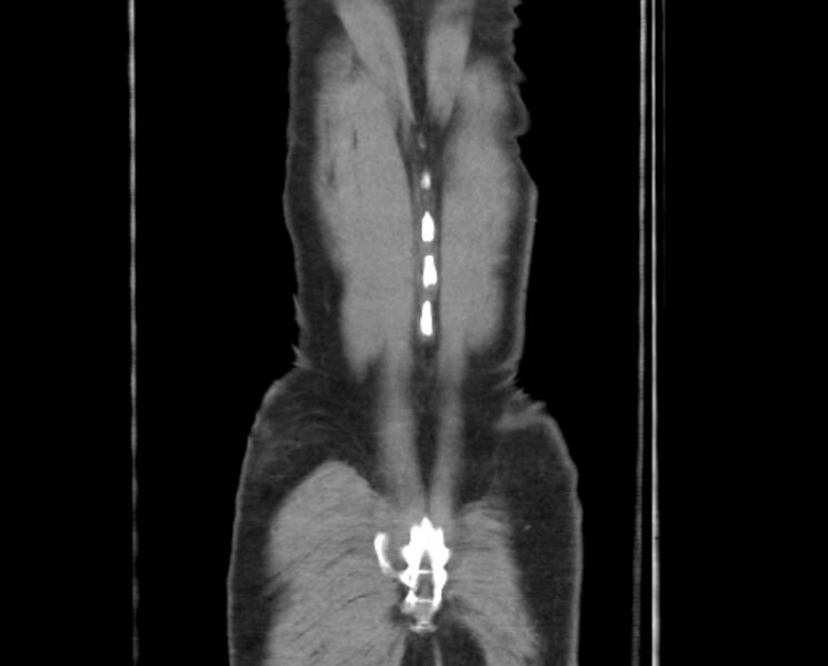 File:Arterial occlusive mesenteric ischemia (Radiopaedia 84641-100060 B 54).jpg
