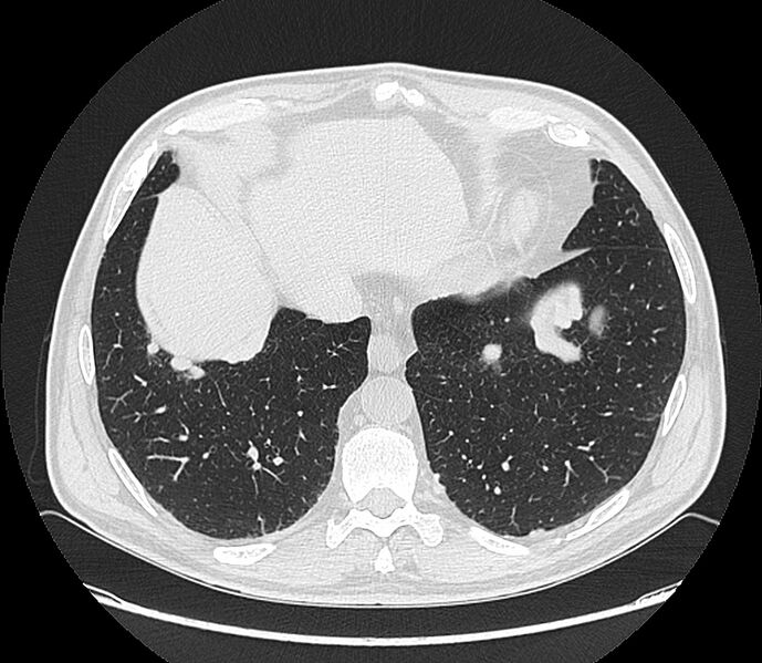 File:Asbestos pleural placques (Radiopaedia 57905-64872 Axial lung window 190).jpg