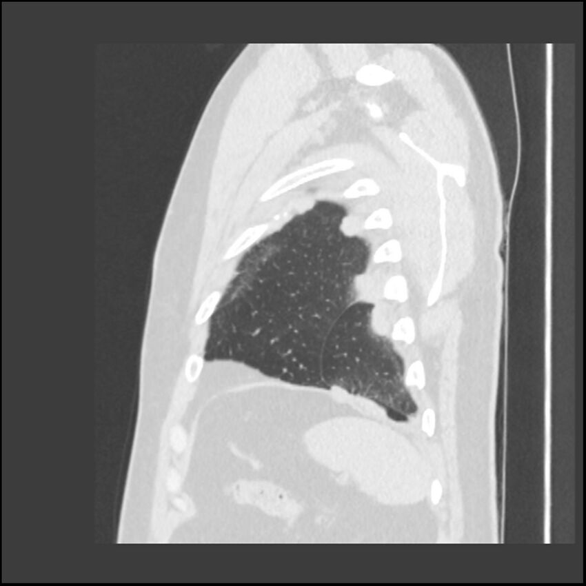 Asbestosis (Radiopaedia 45002-48961 Sagittal lung window 15).jpg