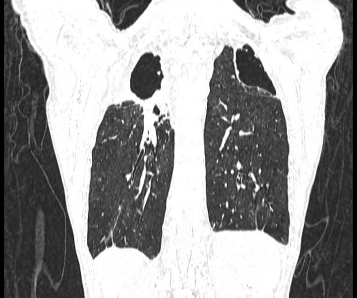 File:Aspergillomas (Radiopaedia 66779-76110 Coronal lung window 16).jpg