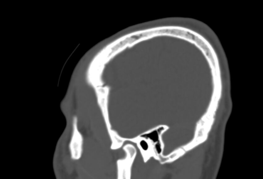 Asymptomatic occipital spur (Radiopaedia 87753-104201 Sagittal bone window 271).jpg